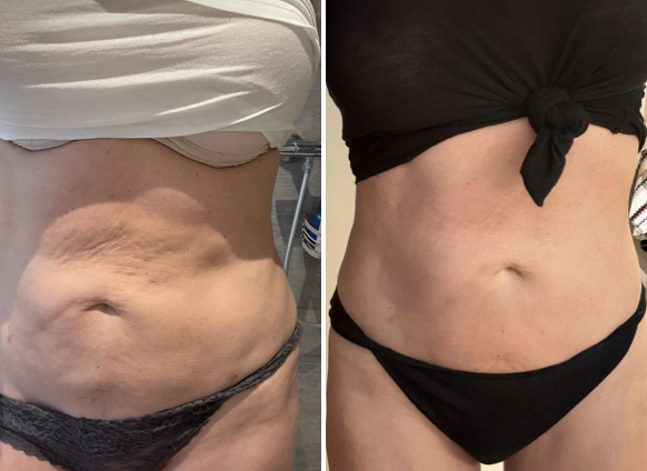 Karolina före och efter